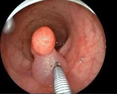 当院の大腸ポリープ切除の実例です 尼崎市の胃腸科 大腸内視鏡 呼吸器内科 外科 中村クリニック